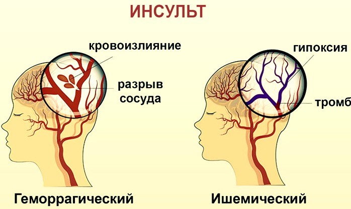 Реабилитация после инсульта в медицинском центре.